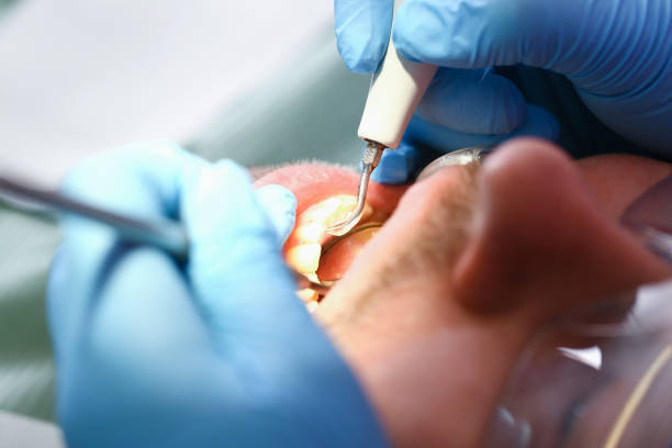 Best Emergency Dental Care for Broken or Chipped Teeth in Seville, FL